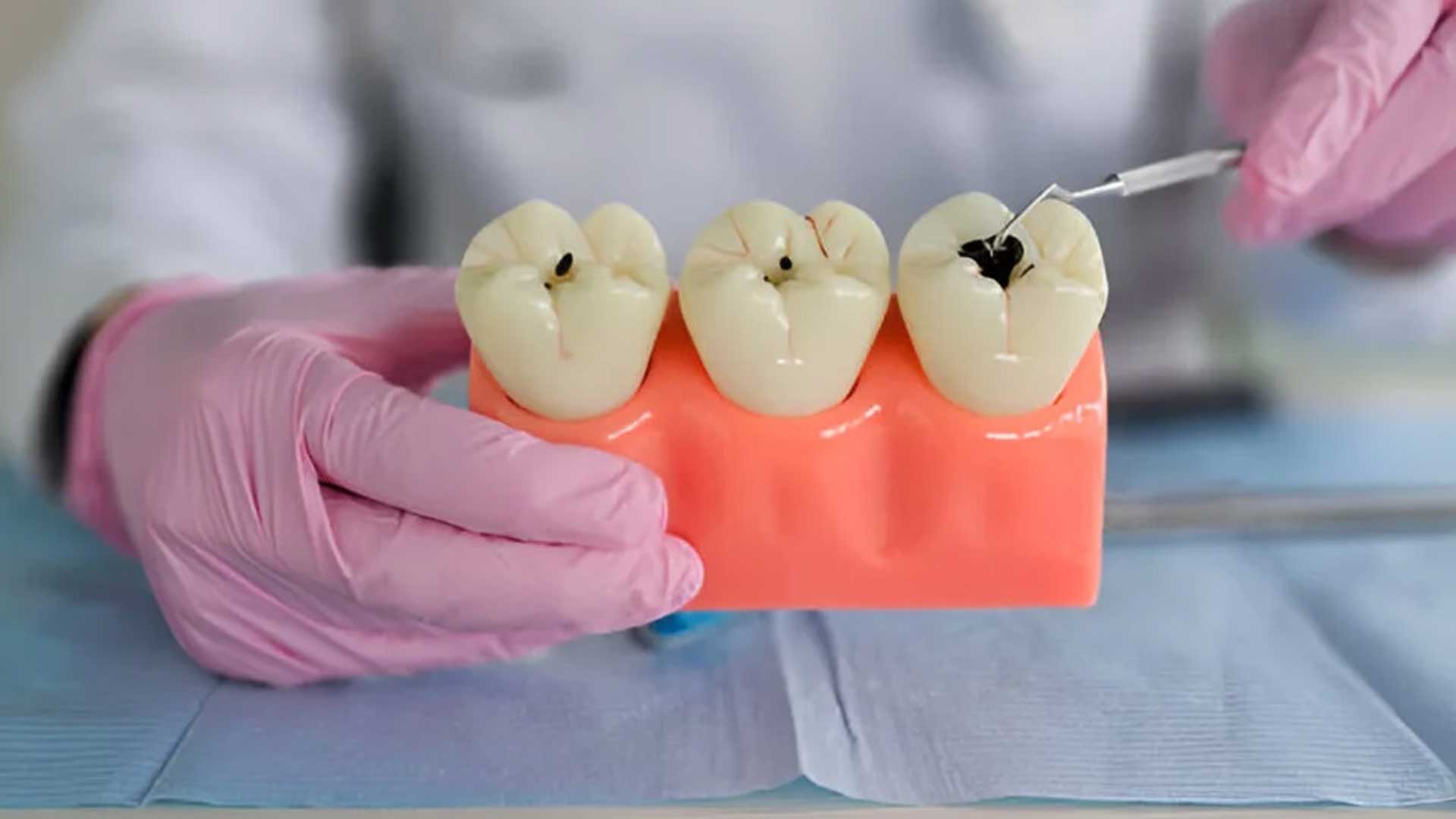 My Dentist @ Highton provides high-quality dental fillings to restore tooth structure and prevent further decay.