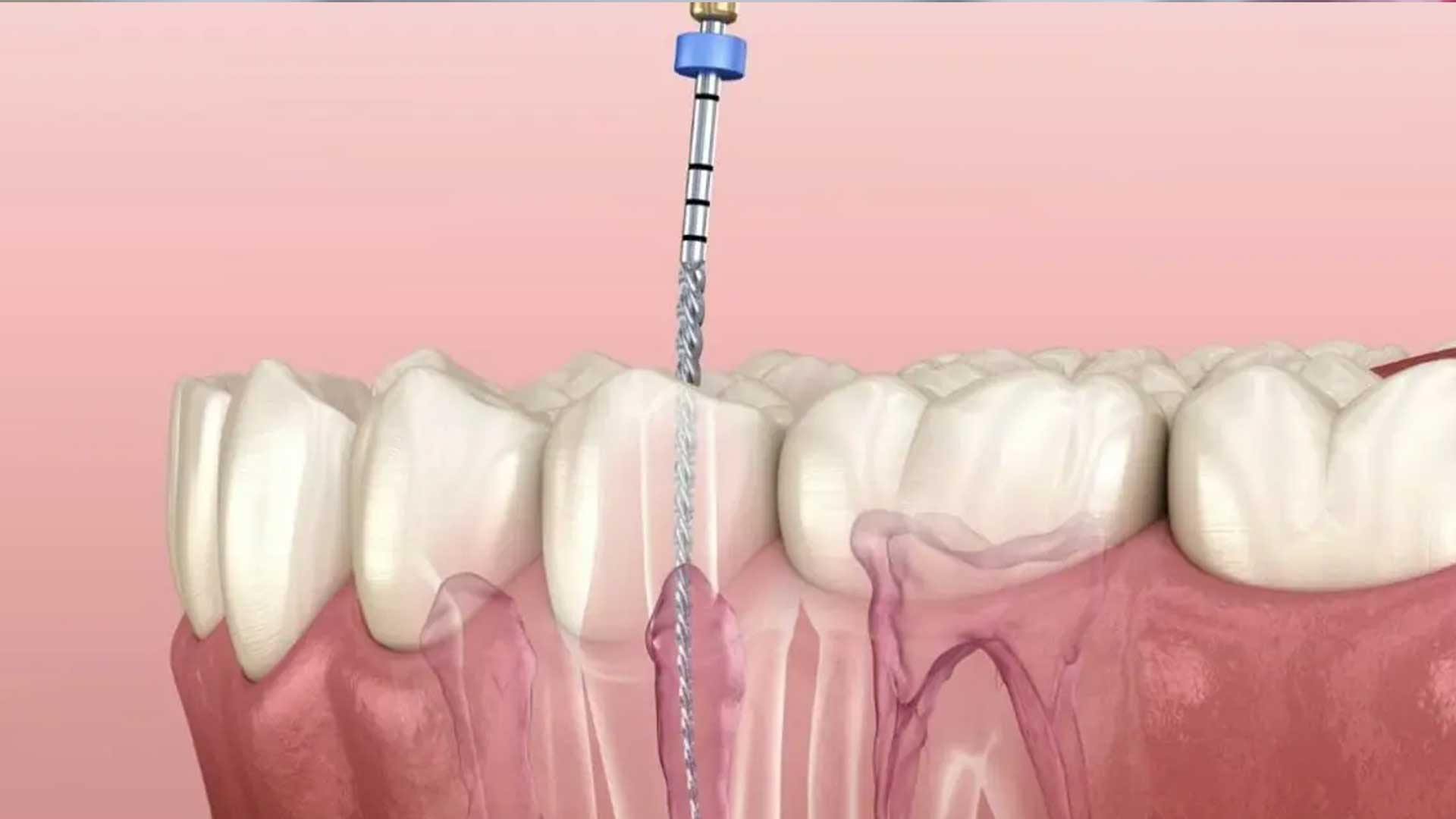 Expert root canal treatments at My Dentist @ Highton to save damaged teeth and provide immediate pain relief.